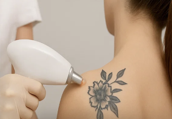 Tattoo Removal